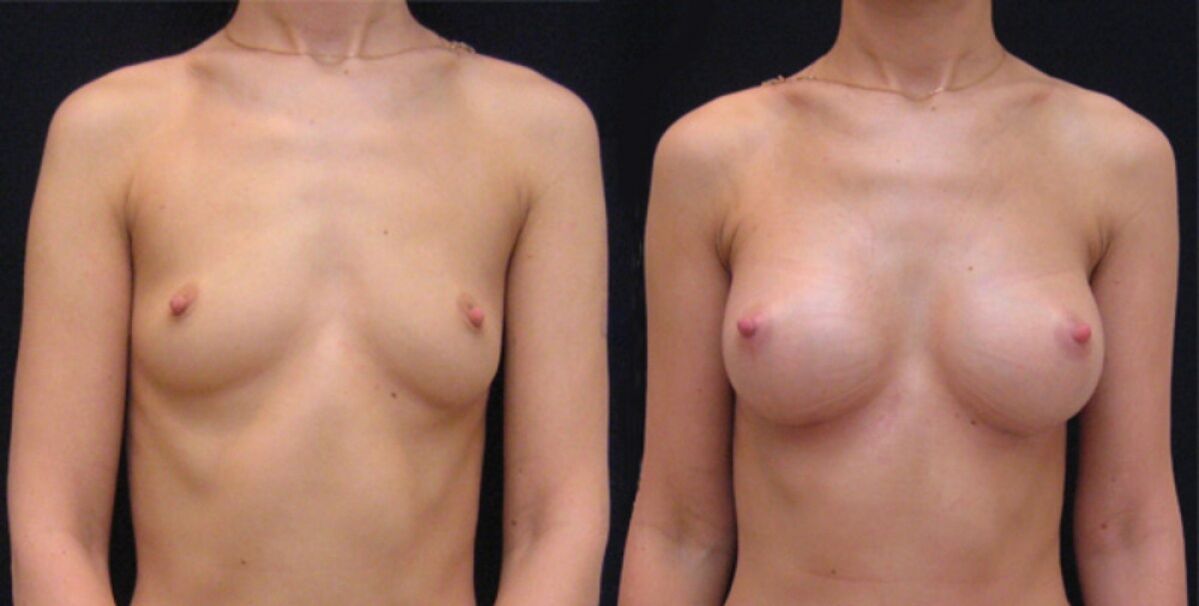 dojke prije i poslije endoskopskog povećanja