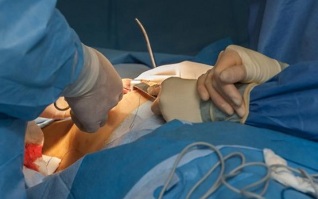 kako se izvodi operacija povećanja grudi
