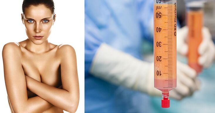 lipofiling kao metoda povećanja grudi