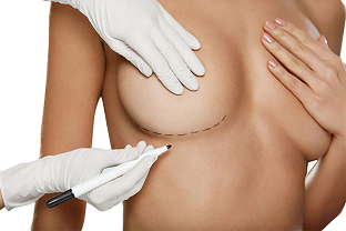 Označavanje markerom prije operacije povećanja grudi